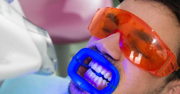 Tooth Bleaching